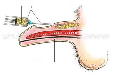 بزرگ کردن آلت تناسلی با تزریق
